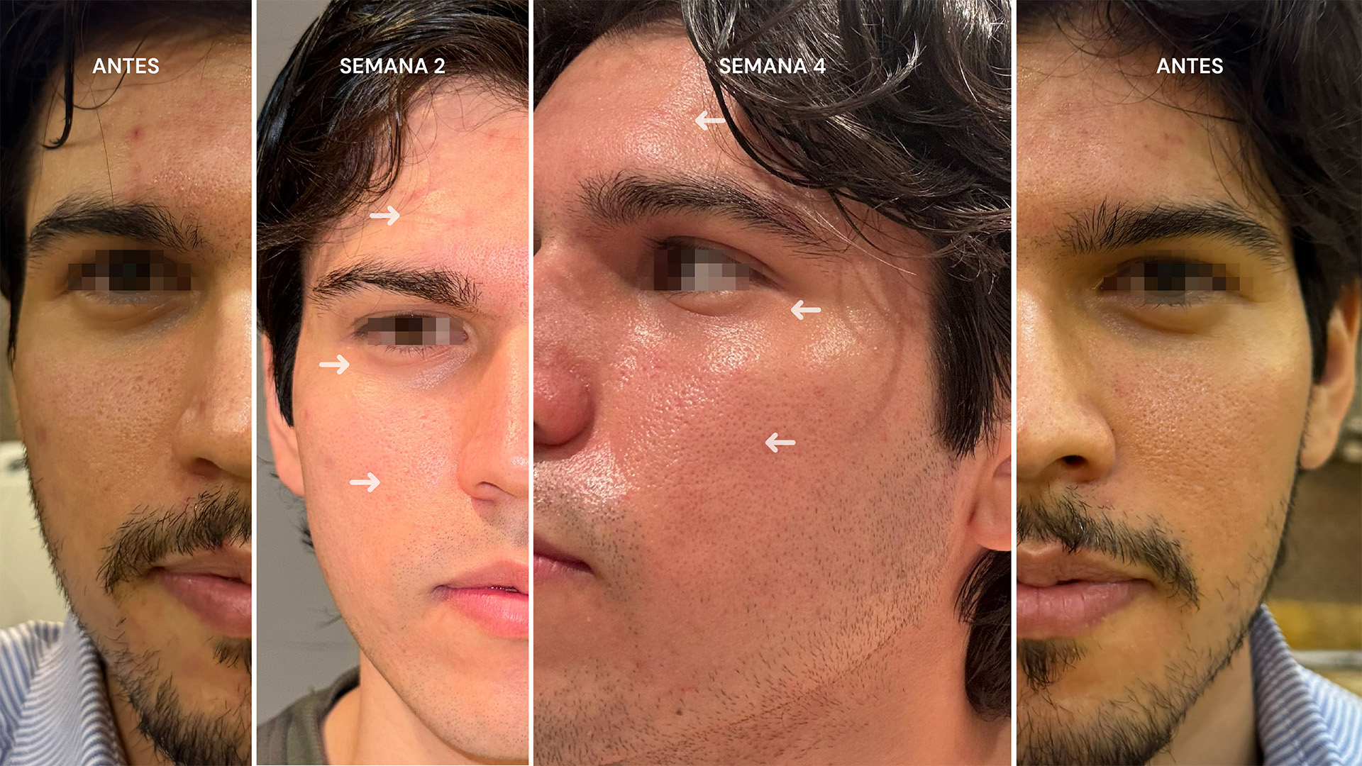 testimonio personal con ageLOC LumiSpa iO antes y ahora